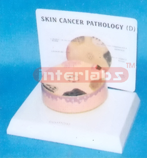 HUMAN SKIN CANCER MODEL WITH DESCRIPTION PLATE